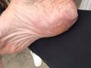 Exfoliating foot peel 